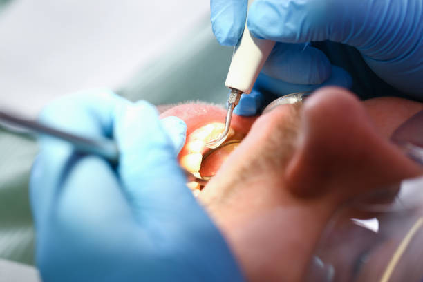 Best Emergency Dentist for Lost Fillings or Crowns in Park City, UT